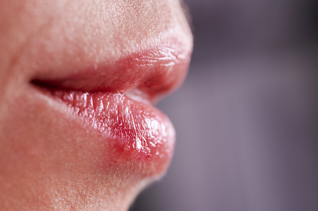 Fieberblasen immer wieder? Warum Herpes oft ein Warnsignal deines Immunsystems ist