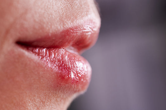 Fieberblasen immer wieder? Warum Herpes oft ein Warnsignal deines Immunsystems ist